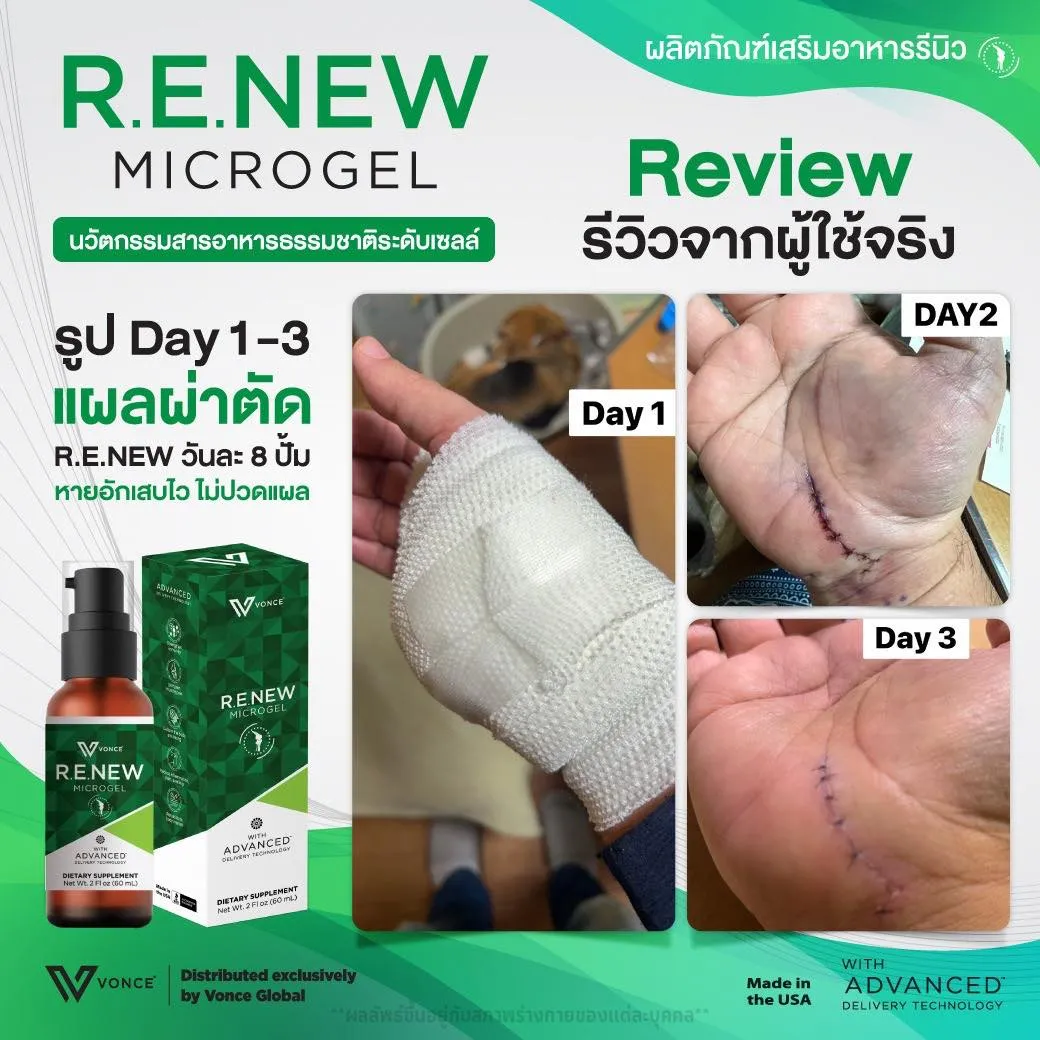 RENEW รีนิว ปวดข้อ ปวดเข่า โรคเก๊าท์ เบาหวาน ออฟฟิศซินโดรม กล้ามเนื้ออักเสบ สะเก็ดเงิน